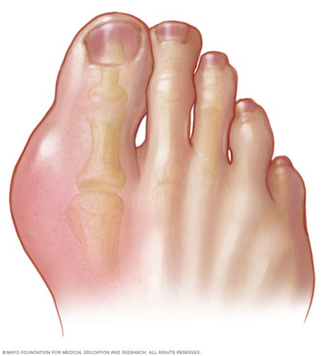gout beacon health system