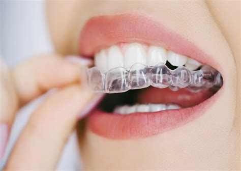 aligner  klar  bali kalm dental care