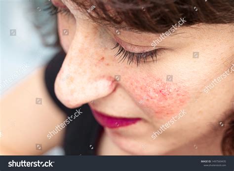 725 Facial Flushing Images, Stock Photos & Vectors | Shutterstock