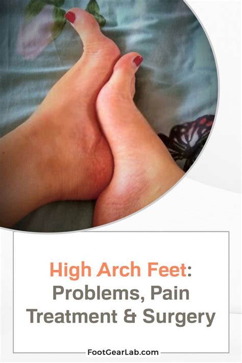 how to fix high arch foot