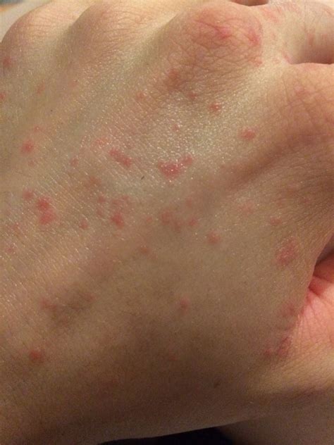 Itchy Rash With Diabetes at Irene Ahmed blog