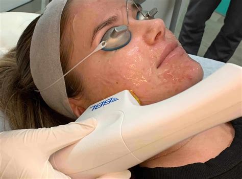 bbl hero  sciton city laser clinic sydney