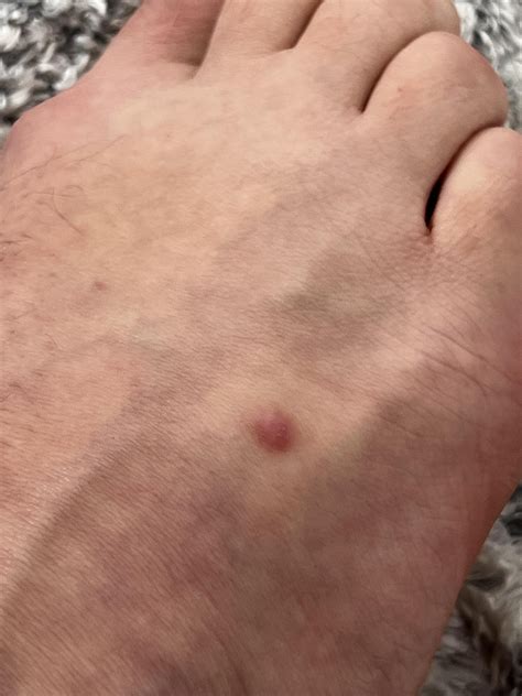 Cellular dermatofibroma : r/medicalcuriosities