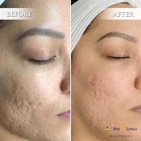Microneedling effects risks cost pain recovery before after – Artofit
