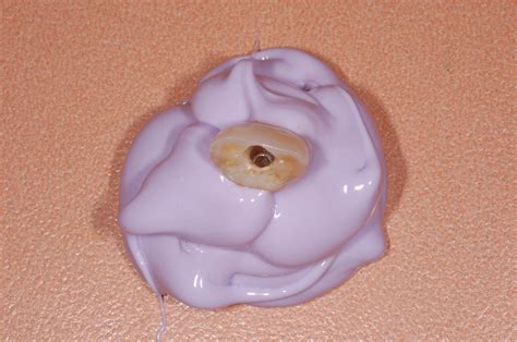 making  custom impression coping bauer smiles