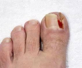 Fungal Nail Treatment | Ingrown Toe Nail Surgery | Best Foot Forward