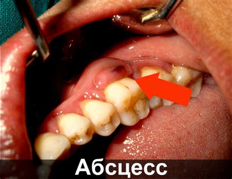 Абсцесс зуба: что это, как лечится и причины возникновения. Лечение ...