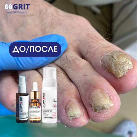 Случай из практики. Грибок, дистрофия ногтя. Благодарим Марину ...