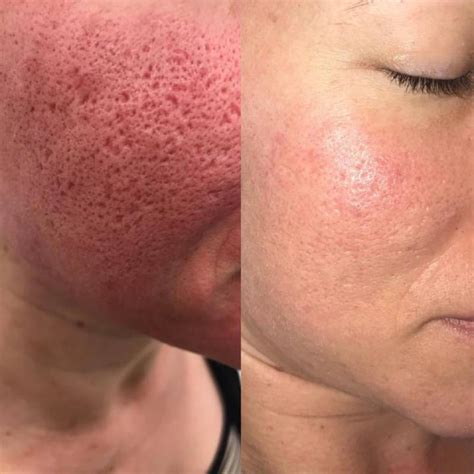 Enlarged Pores Treatment | Laser Treatment For Pores | ELC