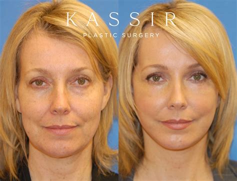 perfect age   face lift kassir plastic surgery