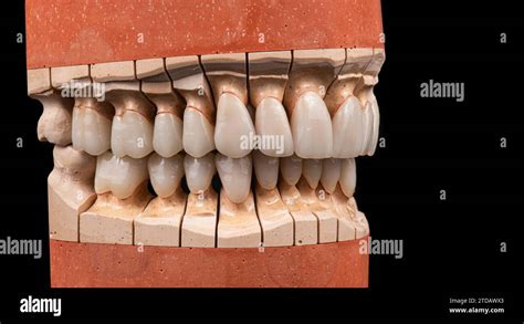 emax crowns and veneers Stock Photo - Alamy