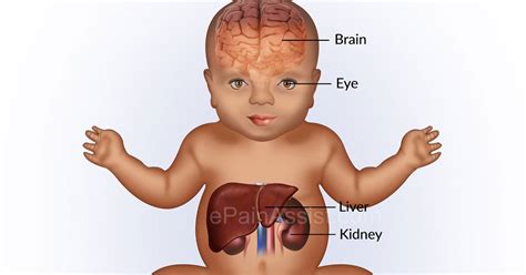 GALACTOSEMIA