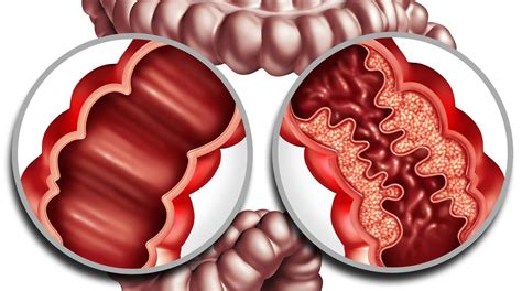 O'que É Doença De Crohn - Doença De Crohn Fisiopatologia - RETOEDU