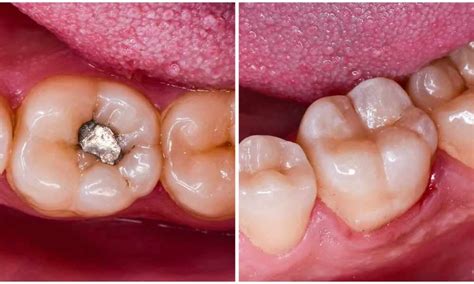 Great Dental Amalgam Debate | Pewaukee Natural Dentist