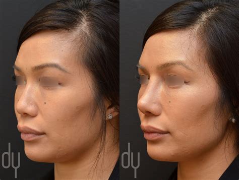 Ear Cartilage Rhinoplasty
