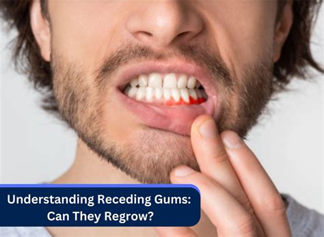 Can Gums Regrow After Gingivitis at Spencer Maconochie blog