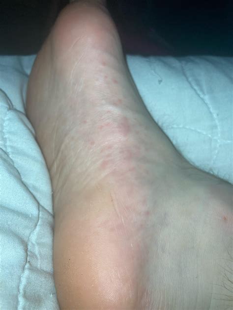 These bumps appeared on my foot, is from wearing sweaty socks all day