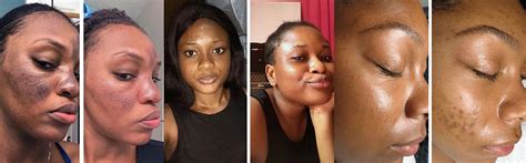 Kojic Acid Soap Before After Kojic Acid Soap – Unamiskincare