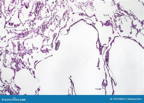 Lung Emphysema, Light Micrograph Stock Photo - Image of obstructive, nontumor: 139733834