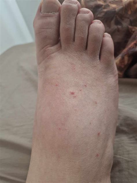 Is it pityriasis lichenoides chronica ??? : r/DermatologyQuestions