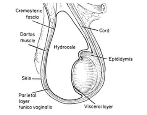 Hydrocele Treatment & Medicine In Kolkata- Dr. Roy's Clinic