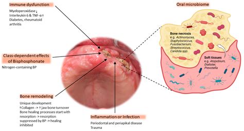 Osteonecrosis Of Jaw Symptoms