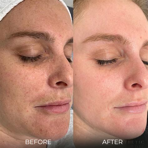 Spot-Off™ Freckle Whitening Cream – thedealzninja
