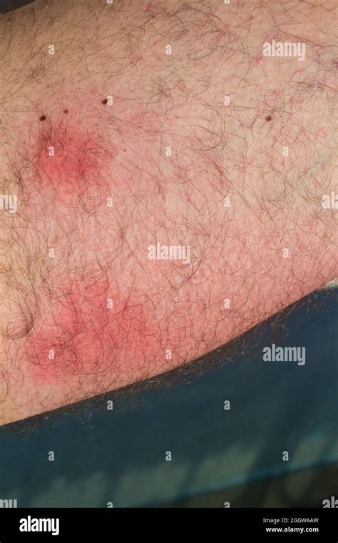 Wasp stings on skin after two day, red inflammation marks caused by ...