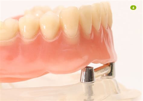 implantes3 - Clínica Dental Badajoz y Mérida. Expertos en Implantes ...