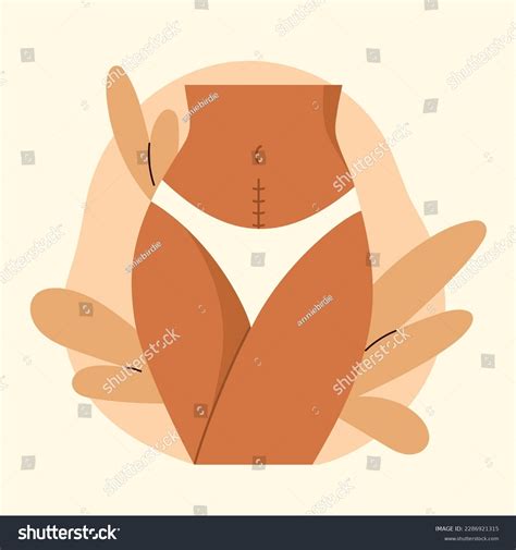 Cesarean Scar Stitches After Caesarean Section Stock Vector (Royalty