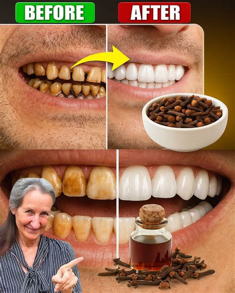 Naturally Reverse Early Tooth Decay: 6 Proven Tips to Strengthen Enamel