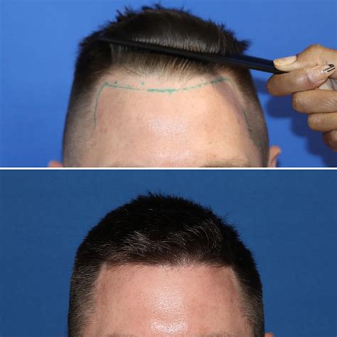 hair transplant in new jersey 8