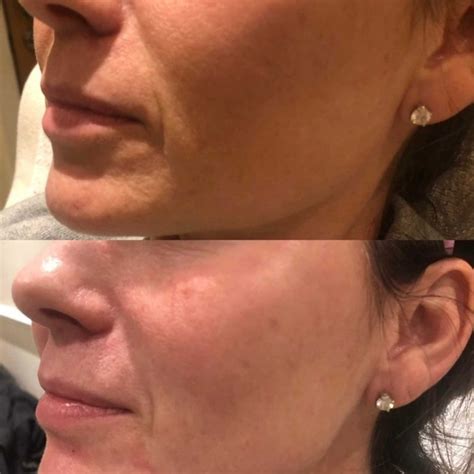 A SLIMMER, MORE DEFINED FACE COULD BE JUST A FEW BOTOX INJECTIONS AWAY