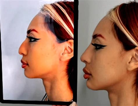 Explante De Silicone Antes E Depois - Segurando próteses de silicone, ex-Tiazinha Suzana Alves tem alta após ...