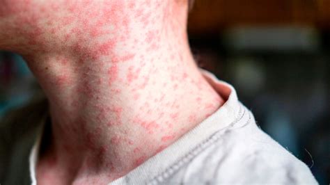 Signs and symptoms of measles - spunout