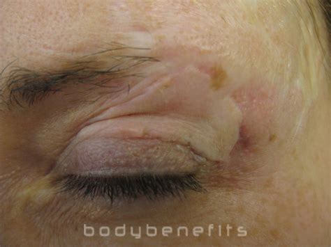 Scar Repair - Bodybenefits Galway Ireland