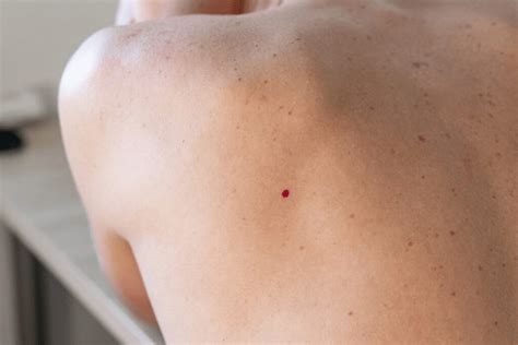 angioma skin  cancer institute