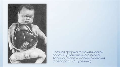 Гемолитические заболевания. Гемолитическая болезнь новорожденных ...