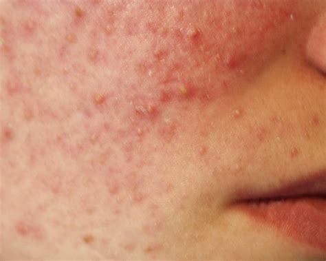 Scalp Folliculitis Causes Symptoms And Treatment - vrogue.co