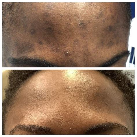 African American Hyperpigmentation Before and After St. Louis