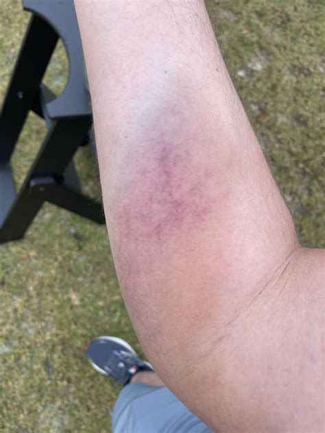 Ruptured forearm? : r/golf