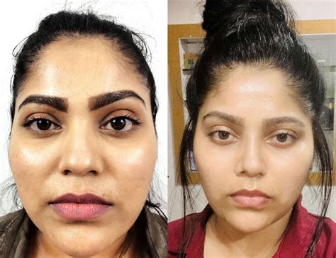 Wide nose bridge, hypertelorism: what is this, causes, symptoms ...