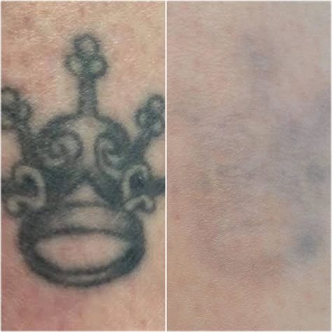 In Progress — Evolve Tattoo Removal | San Diego's Leader in Laser