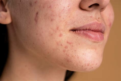 Malassezia Folliculitis: Gejala, Penyebab, dan Cara Mengobati