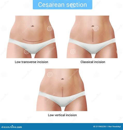 Cesarean Section Stitches Composition Stock Vector - Illustration of