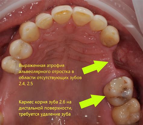 Костная пластика и имплантация зубов | Стоматология Улыбка