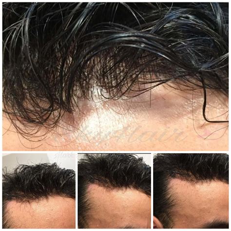 hair patch