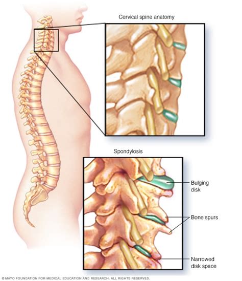 Cervical spondylosis - Mayo Clinic