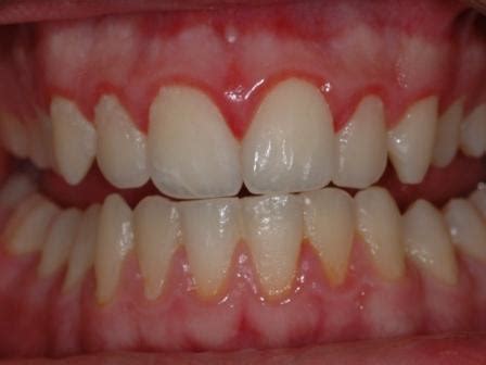 gingivitis