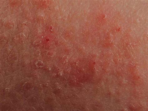 how to stop eczema itching immediately home remedies